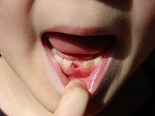 3 10 - مراحل رشد دندان شیری و دائمی در کودکان