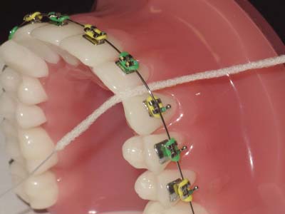 types of dental floss superfloss 2 - نخ دندان و مسواک های بین دندانی ارتودنسی