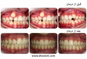 قبل و بعد از ارتودنسی مودکان _ دکتر فرزین اصلانی