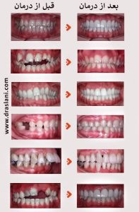 نمونه کار ارتودنسی کودکان _ دکتر فرزین اصلانی