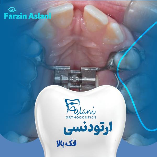 عکس ارتودنسی فک بالا