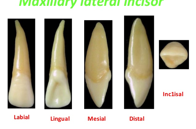 1 1 638x420 - دندان لترال میخی شکل و درمان آن