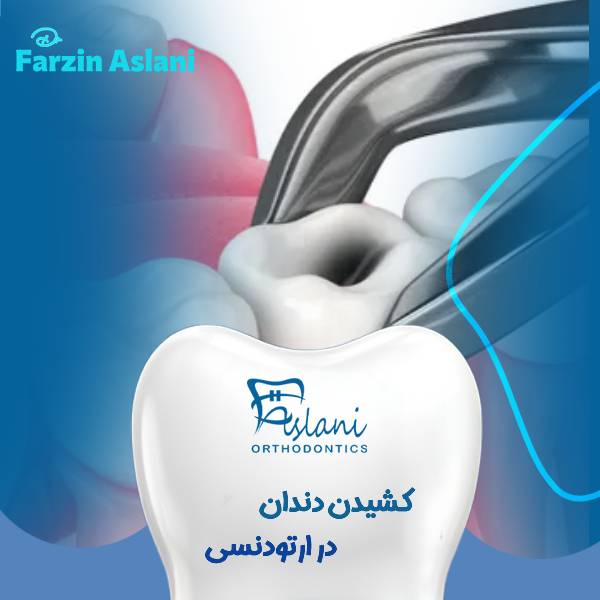 کشیدن دندان در ارتودنسی