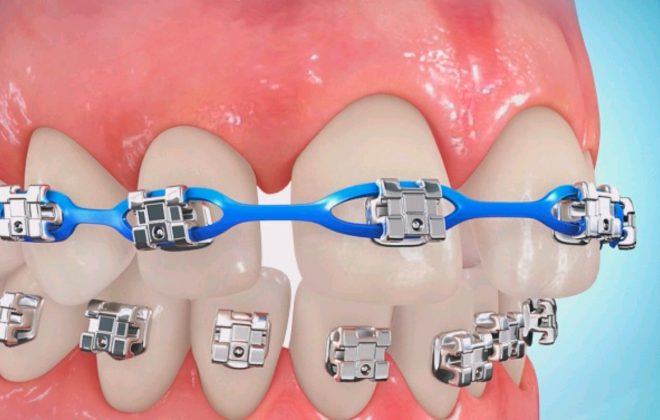 0 1 1 660x420 - ارتودنسی برای بستن فاصله بین دندان‌ها