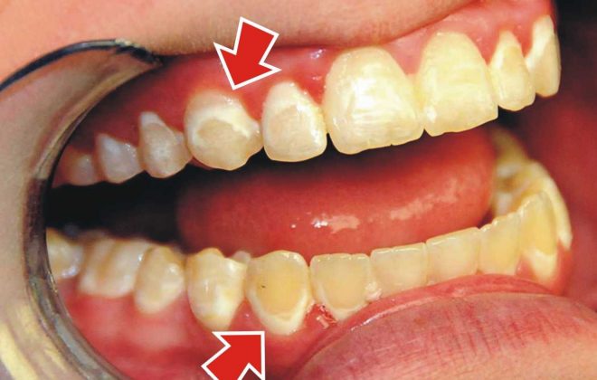 1 1 1 660x420 - تغییر رنگ دندان در ارتودنسی