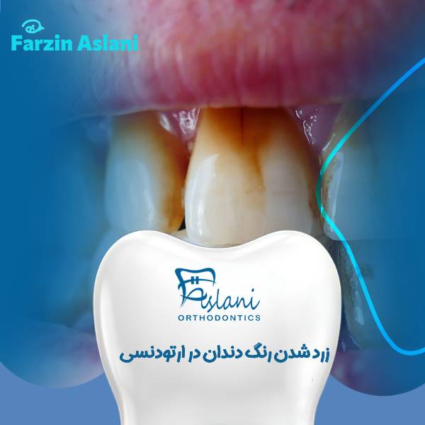 زرد شدن رنگ دندان بعد از ارتودنسی