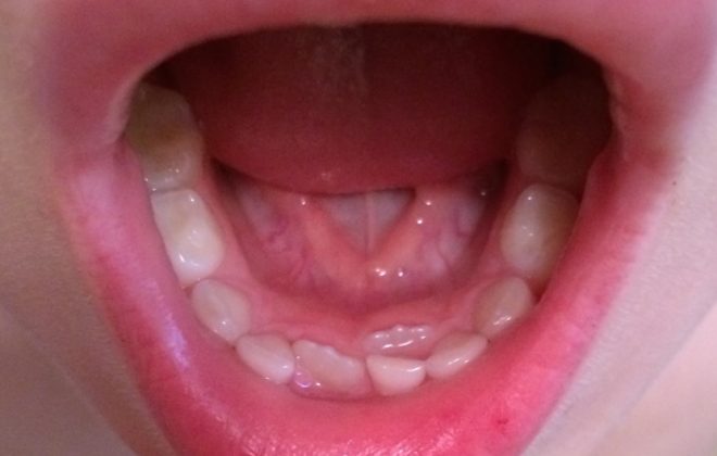 0 3 660x420 - دندان کوسه ای در کودکان
