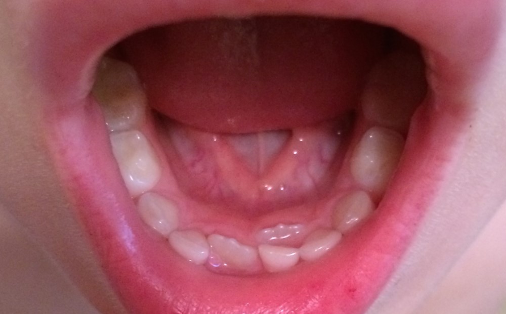0 3 - دندان کوسه ای در کودکان