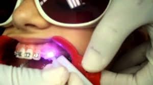کاربرد لیزر در ارتودنسی و دندانپزشکی
