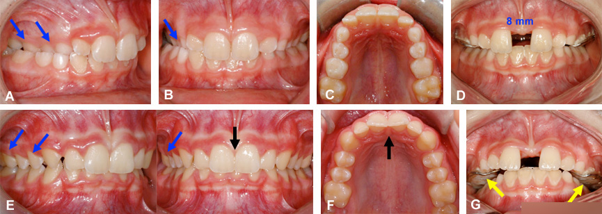 diasteme espace expansion maxillaire orthodontie sherbrooke - ارتودنسى فك بالا