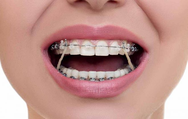 elastics in orthodontic treatment 660x420 - ارتودنسي دندان يا سيم كشى دندان؟!