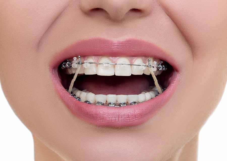 elastics in orthodontic treatment - ارتودنسي دندان يا سيم كشى دندان؟!