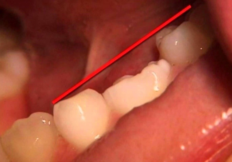 2 1 - انکیلوز دندان
