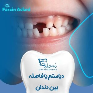 دیاستم یا فاصله بین دندان