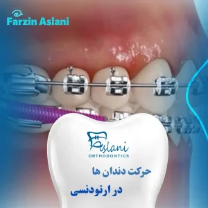 حرکت دندان در ارتودنسی _ دکتر فرزین اصلانی