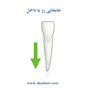 جابه جایی دندان ها به داخل _ دکتر فرزین اصلانی