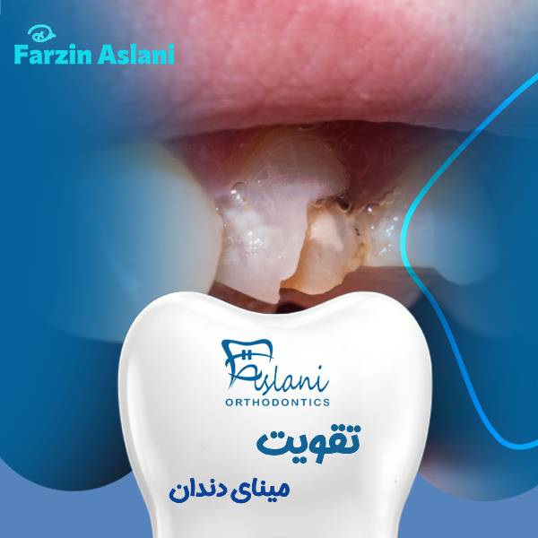 تقویت مینای دندان