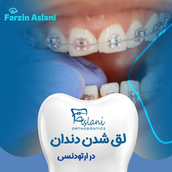لق شدن دندان ارتودنسی شده