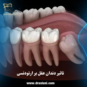 کشیدن دندان عقل قبل از ارتودنسی _ دکتر فرزین اصلانی