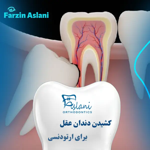 کشیدن دندان عقل برای ارتودنسی _ دکتر فرزین اصلانی