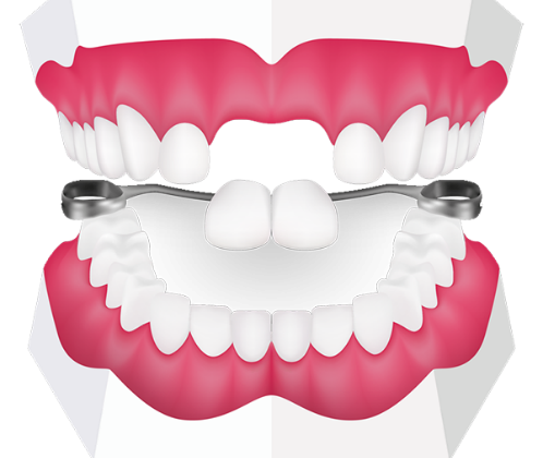 21 498x420 - دندان مصنوعی یا پروتز دندان کودکان