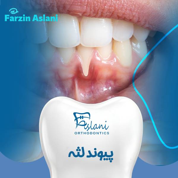 عکس پیوند لثه | دکتر فرزین اصلانی