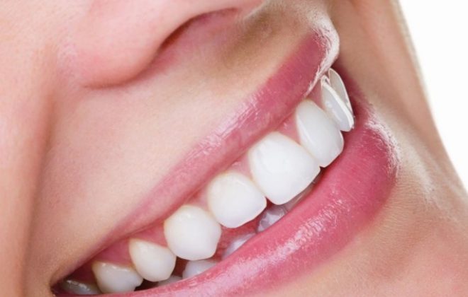 11 660x420 - آشنایی با روش های سفید کردن دندان