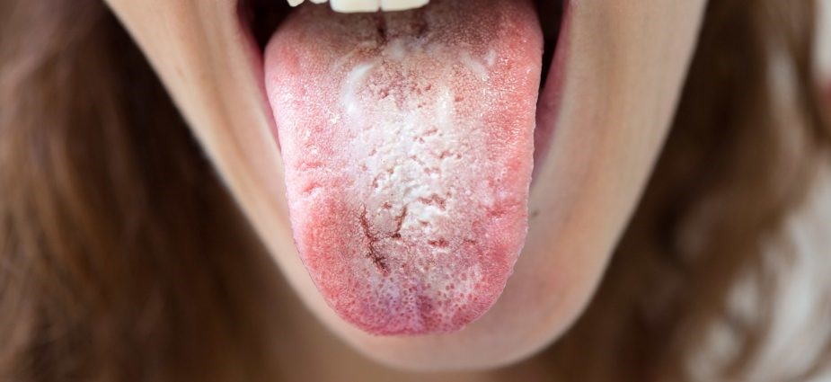1 1 - برفک دهان؛ علل و درمان های آن