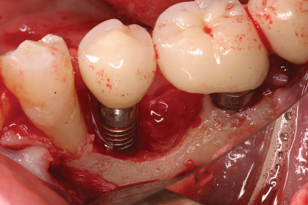 3 1 - ایمپلنت های دندانی و فرایند کاشت آنها