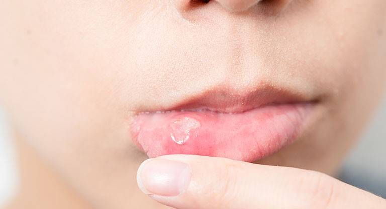 3 - برفک دهان؛ علل و درمان های آن