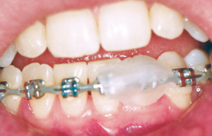 3 - نحوه مواجه شدن با زخم های دهان در طول درمان ارتودنسی