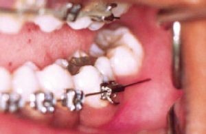 4 1 - نحوه مواجه شدن با زخم های دهان در طول درمان ارتودنسی
