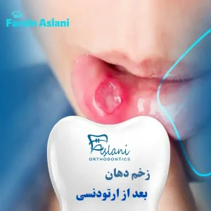 زخم دهان بعد از ارتودنسی