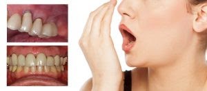 5 - آیا روکش دندان ها باعث بروز بوی بد دهان می شوند؟