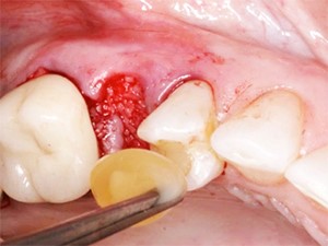 6 1 - پی آر پی، پی آر اف و پی آر جی اف: چه کاربردهایی در دندانپزشکی دارند؟
