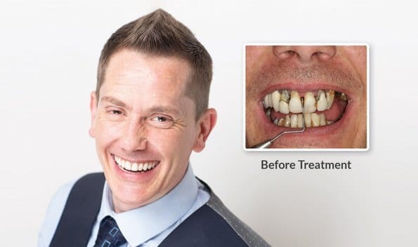 14 - با کاشت ایمپلنت دندان فوری در یک روز لبخند بزنید