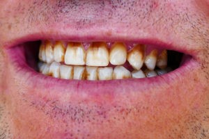 2 - مضرات سیگار الکترونیک برای دهان و دندان ها