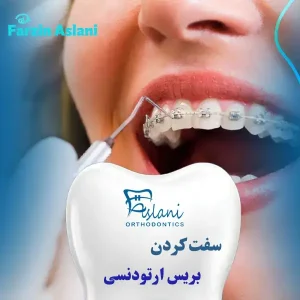 سفت کردن بریس ارتودنسی _ دکتر فرزین اصلانی