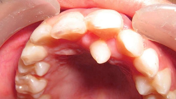 3 - دندان اضافه و مشکلات ناشی از آن