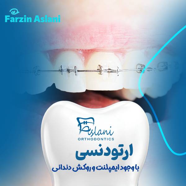 ارتودنسی دندان روکش شده
