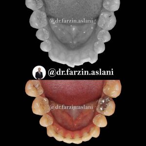 نمونه کار ارتودنسی ثابت _ دکتر فرزین اصلانی