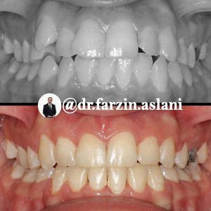 قبل و بعد ارتودنسی ثابت _ دکتر فرزین اصلانی