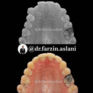 نمونه کار ارتودنسی ثابت در تهران _ دکتر فرزین اصلانی
