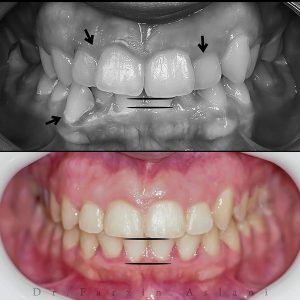 مراقبت از ارتودنسی شفاف _ دکتر فرزین اصلانی