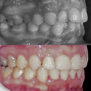 مراقبت از ارتودنسی نامرئی _ دکتر فرزین اصلانی 