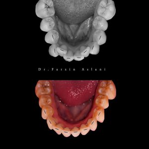 نمونه کار ارتودنسی نامرئی _ دکتر فرزین اصلانی