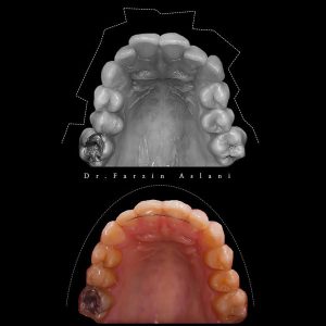 مراقبت های بعد از ارتودنسی شفاف _ دکتر فرزین اصلانی