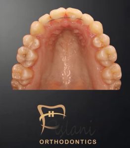 عکس ارتودنسی ثابت در تهران _ دکتر فرزین اصلانی