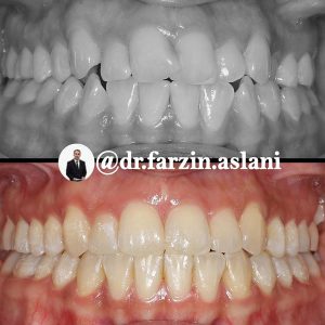 ارتودنسی ثابت _ دکتر فرزین اصلانی