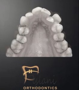 نمونه کار ارتودنسی ثابت در تهران _ دکتر فرزین اصلانی